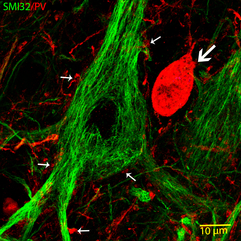 SMI32-immunfestett (zöld) humán óriás piramissejt (Betz-sejt) és egy szomszédos parvalbumin (PV)-immunopozitív (piros) interneuron (nagy nyíl) nagy nagyítású konfokális képe. A kis nyilak PV-pozitív periszomatikus terminálisokat jelölnek.