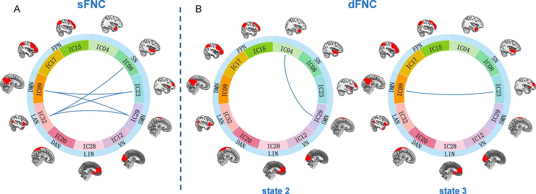 A funkcionális hálózatok egészséges emberben jellegzetes mintázatban váltjk egymást. A tudatot érintő megbetegedések során a mintázatok váltakozása megváltozik. Az ábra azt mutatja, hogy késői megjelenésű depresszóban hogyan változik meg a funkcionális hálózatok kölcsönhatása. A) sFNC (static functional connectivity) azt mutatja meg, hogy egy depressziósban mely hálózatok közötti kölcsönhatások gyengülnek (kék vonalak) úgy általában. B) a dFNC azt mutatja, hogy eltérő rövidebb időszakok, agyi állapotok alatt mely kapcsolatok gyengülnek. Abbreviations: IC: independent component X (egymástól független működésű agyterületek, melyek a funkcionális hálózatokat alkotják); DMN: default mode network (Én); FPN: frontoparietális hálózat (tervezés); SN: salience network (jelentőség észlelés); SMN: szenzorimotoros hálózat; VN, látó hálózat; LIN: limbikus (érzelmi) hálózat; DAN: dorsal attention network; LAN: nyelvi hálózat