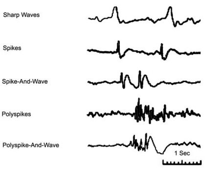 Különböző alakú rövid epilepsziás kisülések. Az idegsejtek rövid ideig tartó erős, összehangolt kisülését jelzik.