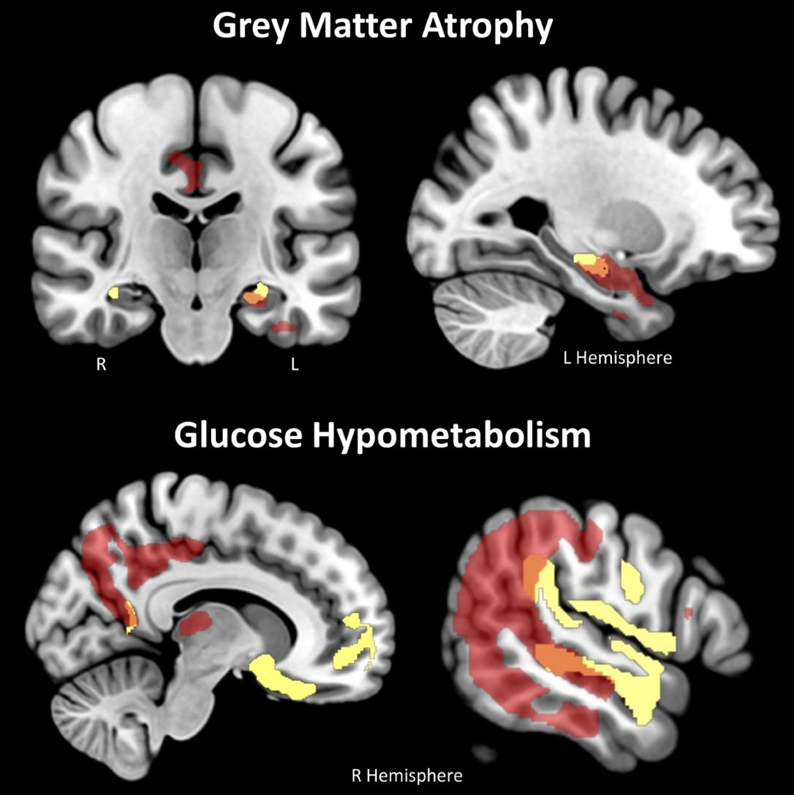 A szürkeállomány károsodása (felső sor), illetve az agyi aktivitás csökkenése (alsó sor) figyelhető meg mind a depressiósok (sárga), mind az Alzheimer kórosok (piros) agyában. A mindkét betegség által érintett területeket narancssárga jelöli. Depresszióban károsodás (fent) figyelhető meg a hippokampuszban, aktivitás csökkenés (lent) a homloklebenyben és a halántéklebenyben.
