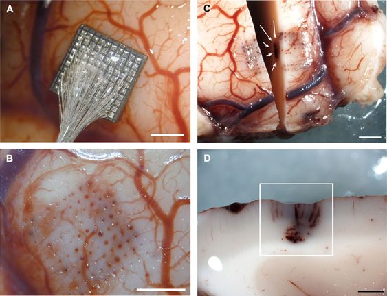 A) Patkány agykérgébe szúrt 8x8, azaz 64 elektródasort hordozó mikroelektróda rács, B) Az eltávorított rács által okozott sérülések az agyban, C) Egyetlen felnyagyított elektródasor, D) Az agyfelszínre merőlegesen vágott szövettani metszet, mely az elektródák elhelyezkedésének megállapítására készült a kísérlet után.