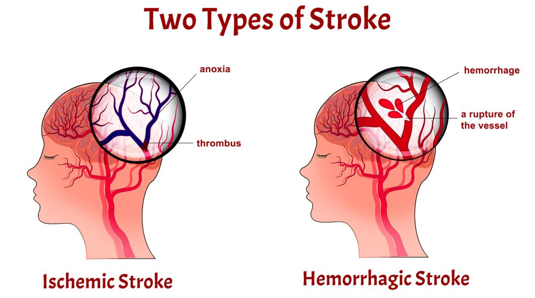 A stroke-ot az agyi erek vérzése vagy a véráramlás valamilyen akadály miatt megállása okozhatja.
