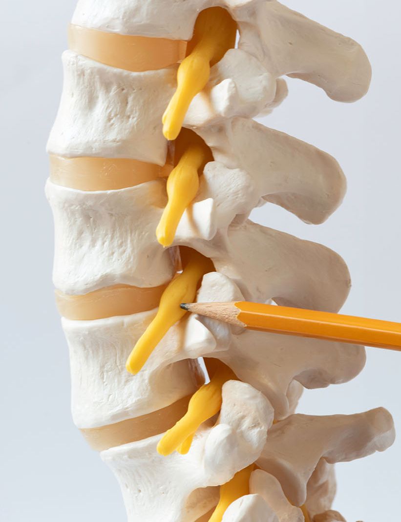 A csigolyák közt belépő idegek iedegsejtjei a hátsó gyöki dúcban vannak, beszorítva a csigolyák nyúlványai közé. Amikor gyulladástól megduzzadnak fájdalmas nyomás alakul i bennük.