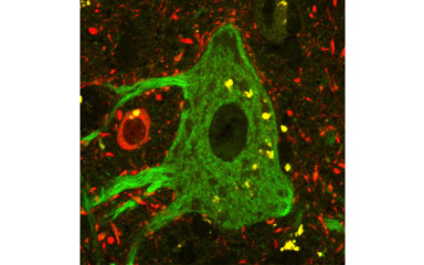 Investigation of cortical abnormalities in schizophrenia patients