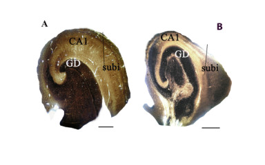 Investigation of cellular, subcellular and network changes in therapy-resistant epilepsies